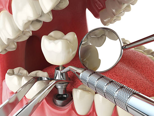 Best Lost Filling or Crown Replacement in Grand Saline, TX